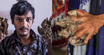 'Tree Man' Shares The Daily Struggle And Pain Of Living With An Incurable Condition That Causes Tree-Like Growths