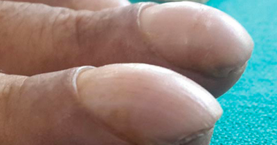 'Clubbing' Explained &mdash; Why A Sudden Change In Your Fingers Could Point To A Serious Disease