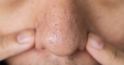 Dermatologist Warns Against Squeezing Black Spots On Your Nose Because They're Not What You Think