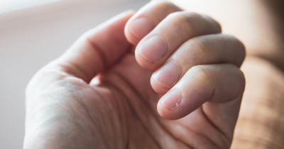 Small Change In Your Fingernails Could Be An Early Warning Sign Of Deadly Cancer Before Other Symptoms Appear