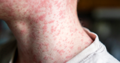 Urgent Warning Issued As US Disease Passes 2,000 Cases For The First Time In 30 Years