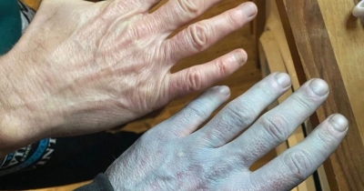 Man Woke Up Completely Blue And Was Rushed To Hospital Before Doctors Realized The Surprising Cause