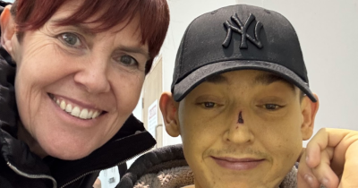 25-Year-Old Woke Up 'Bart Simpson' Yellow &mdash; And The Cause Went Back To Infancy